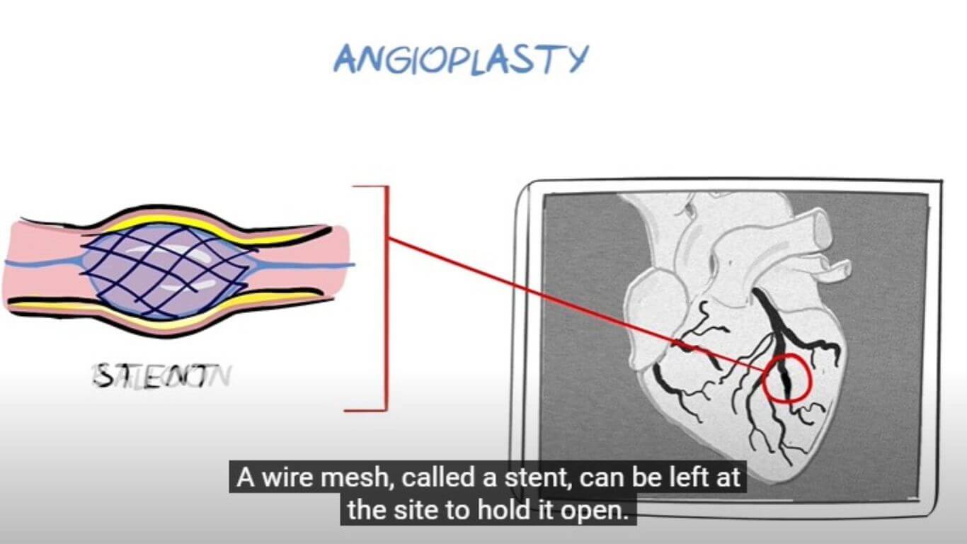 What are the main causes of heart attacks