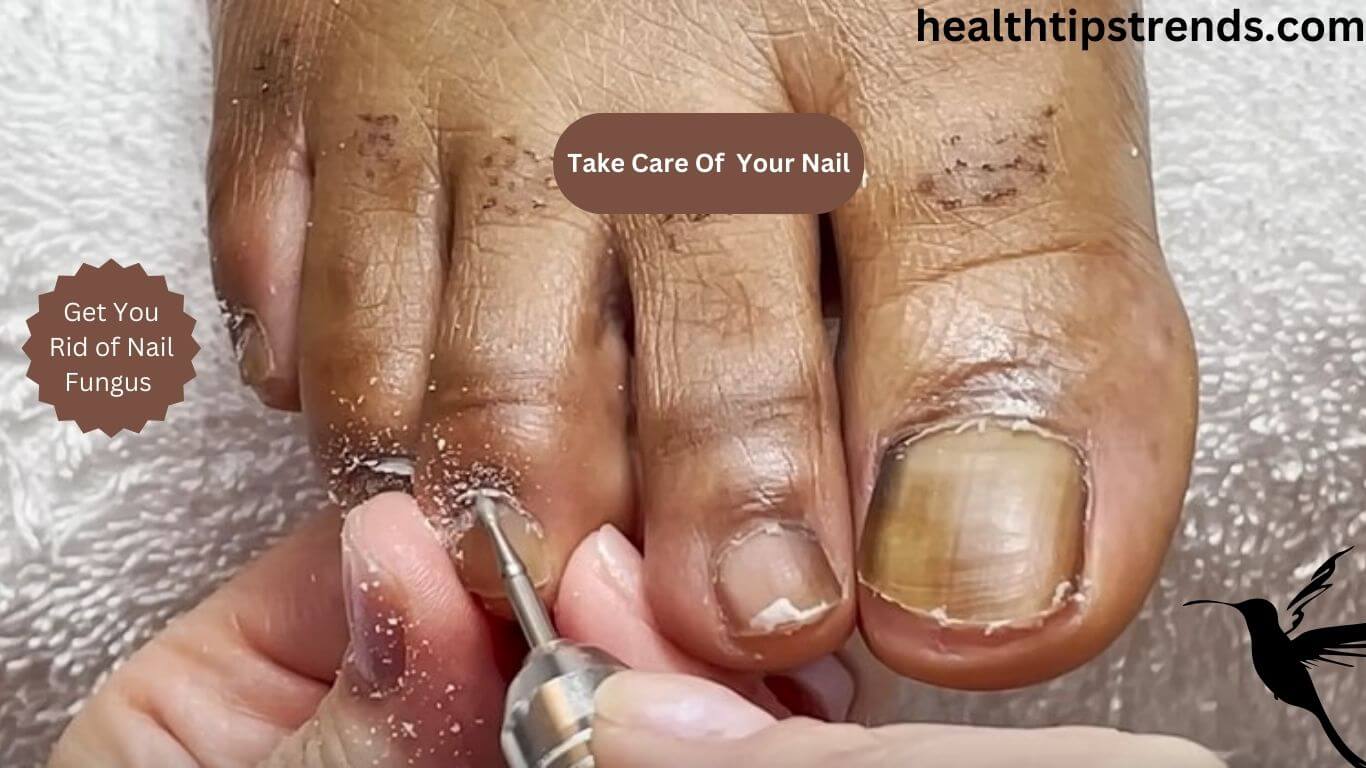 How do you get rid of nail fungus fast