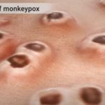 What are the first symptoms of monkeypox?