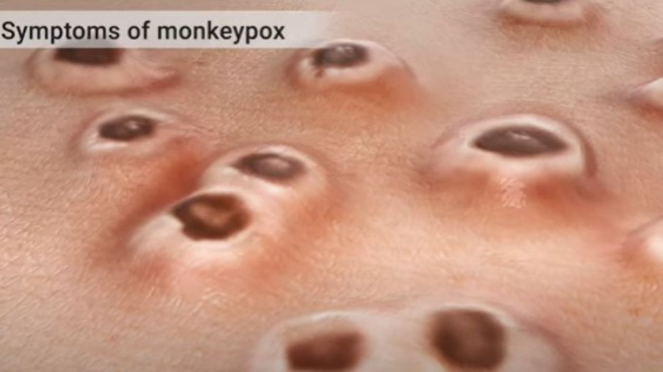 What are the first symptoms of monkeypox?